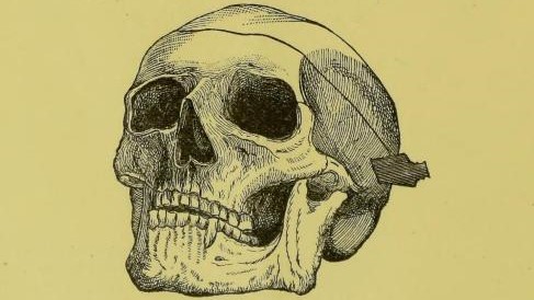 Rycina z Injuries and surgical diseases of the head autorstwa Williama MacCormaca Dzięki uprzejmości Medical Heritage Library, Inc. opublikowano na licencji CC BY-NC-SA 2.0, via Wikimedia Commons